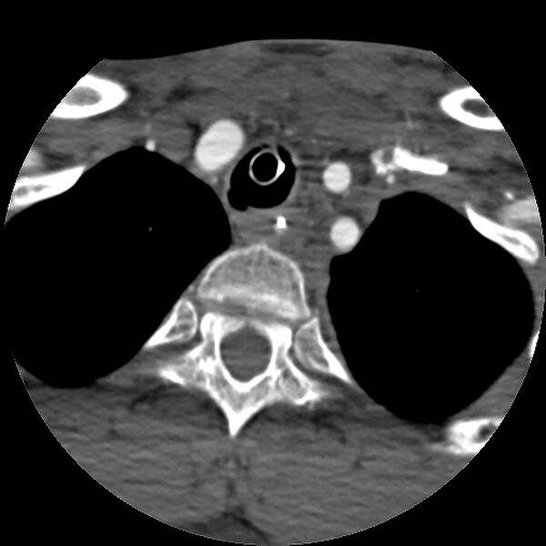 File:Cervical spine fractures with vertebral artery dissection (Radiopaedia 32135-33078 D 13).jpg