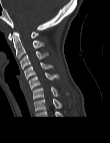 File:Cervical spine posterior ligamentous complex rupture (Radiopaedia 63486-72101 Sagittal bone window 13).jpg