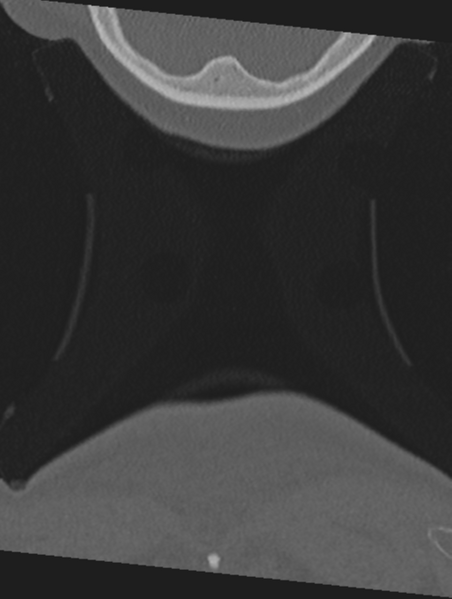 File:Cervical spondylolysis (Radiopaedia 49616-54811 Coronal bone window 79).png