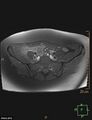 Cesarian scar endometriosis (Radiopaedia 68495-78066 Axial T1 C+ fat sat 3).jpg