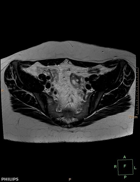 File:Cesarian scar endometriosis (Radiopaedia 68495-78066 Axial T2 6).jpg