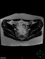 Cesarian scar endometriosis (Radiopaedia 68495-78066 Axial T2 6).jpg