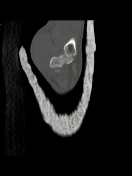 File:Chauffeur's (Hutchinson) fracture (Radiopaedia 58043-65079 Sagittal bone window 20).jpg