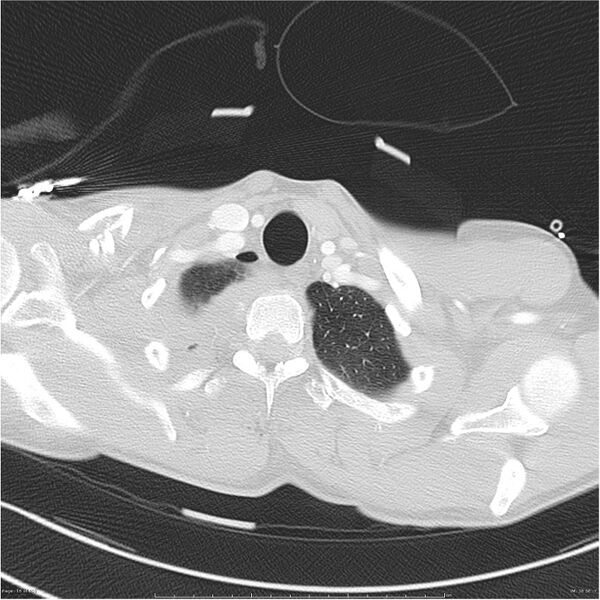 File:Chest and abdomen multi-trauma (Radiopaedia 26294-26425 lung window 16).jpg