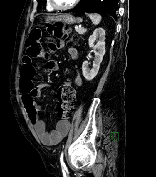 File:Cholangiocarcinoma with cerebral metastases (Radiopaedia 83519-98629 F 39).jpg