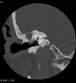 Cholesteatoma (Radiopaedia 5467-7197 Coronal bone window 15).jpg