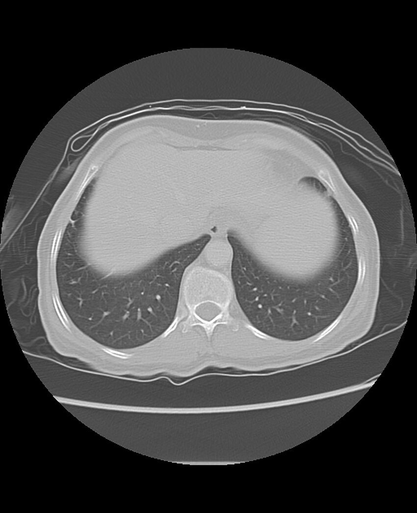 Chondrosarcoma (Radiopaedia 79427-92532 Axial lung window 48).jpg