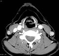 Chondrosarcoma - larynx (Radiopaedia 4588-6698 A 1).jpg