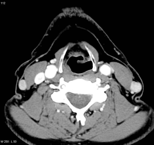 File:Chondrosarcoma - larynx (Radiopaedia 4588-6698 A 1).jpg