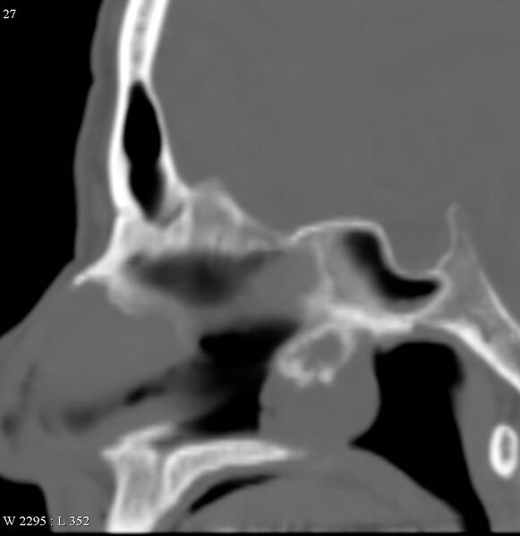 File:Chondrosarcoma - nasal septum (Radiopaedia 5395-7150 B 1).jpg
