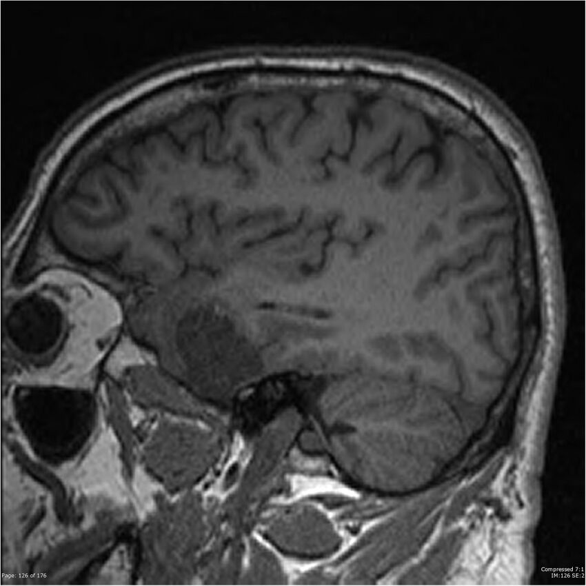 Chondrosarcoma of skull base- grade II (Radiopaedia 40948-43654 Sagittal T1 49).jpg