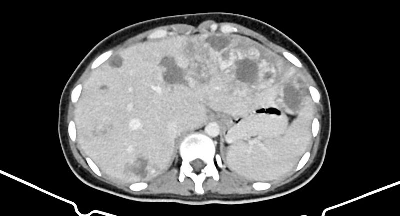 File:Choriocarcinoma liver metastases (Radiopaedia 74768-85766 A 48).jpg