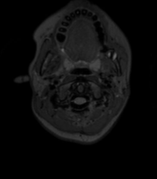 File:Choroid plexus carcinoma (Radiopaedia 91013-108553 Axial T2 fat sat 14).jpg