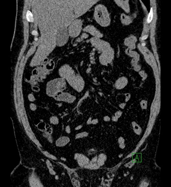 File:Chromophobe renal cell carcinoma (Radiopaedia 84286-99573 Coronal non-contrast 56).jpg