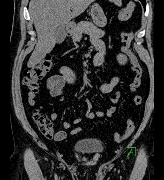 File:Chromophobe renal cell carcinoma (Radiopaedia 84286-99573 Coronal non-contrast 61).jpg
