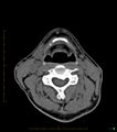 Chronic Submandibular sialolithiasis (Radiopaedia 16880-16606 Axial non-contrast 24).jpg