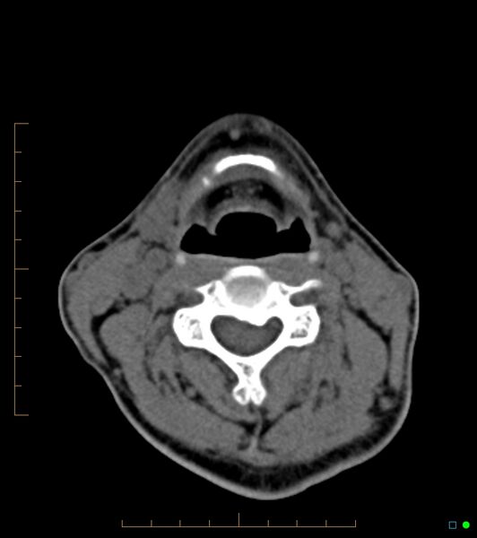 File:Chronic Submandibular sialolithiasis (Radiopaedia 16880-16606 Axial non-contrast 24).jpg