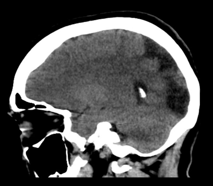 File:Chronic bilateral occipital lobe infarcts (Radiopaedia 31276-31996 C 15).jpg
