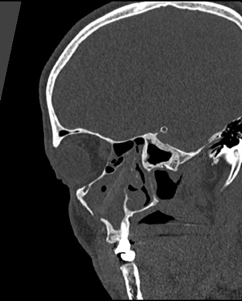 File:Chronic maxillary sinusitis caused by a foreign body (Radiopaedia 58521-65676 Sagittal bone window 18).jpg