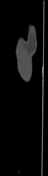 File:Chronic osteomyelitis (with sequestrum) (Radiopaedia 74813-85822 C 6).jpg