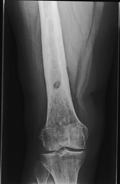 File:Chronic osteomyelitis of the right femur (Radiopaedia 78913-91802 Frontal 1).jpg