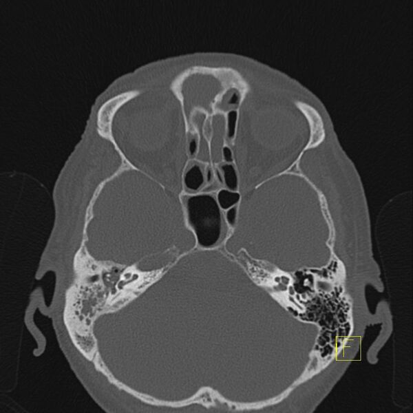 File:Chronic otitis media (Radiopaedia 14994-14912 Axial bone window 10).JPEG