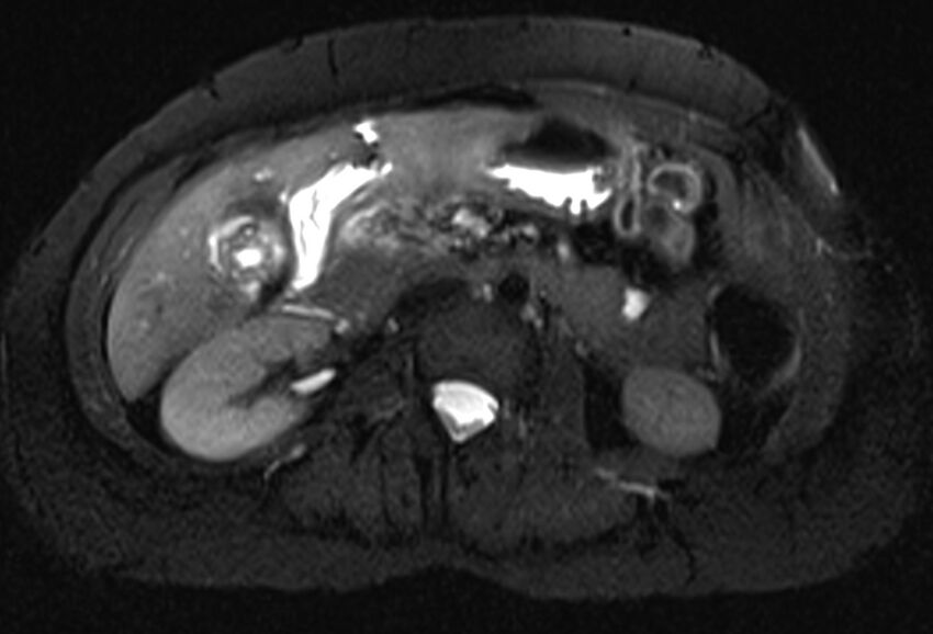 Chronic pancreatitis - pancreatic duct calculi (Radiopaedia 71818-82250 Axial T2 fat sat 36).jpg