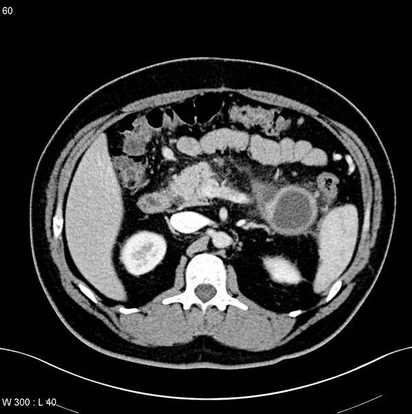 File:Chronic pancreatitis and pseudocysts (Radiopaedia 6724-7935 B 10).jpg
