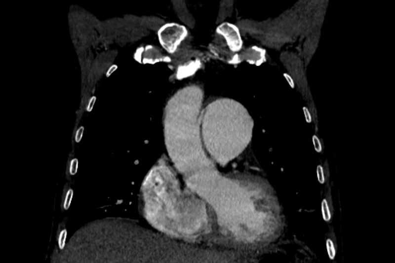 File:Chronic pulmonary embolism with bubbly consolidation (Radiopaedia 91248-108850 B 46).jpg