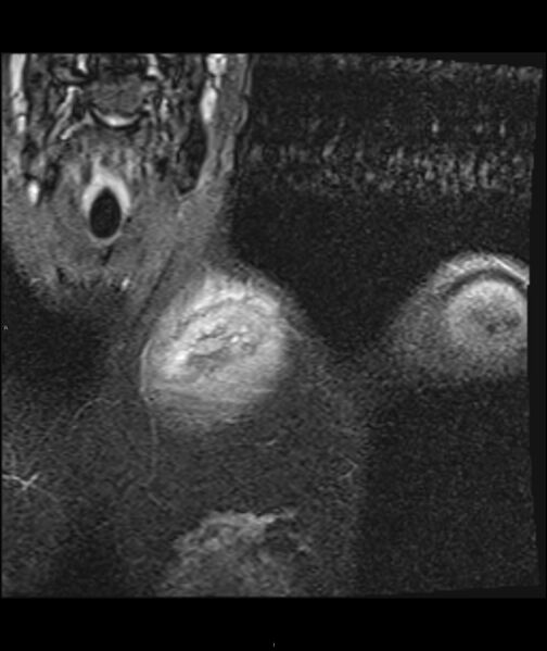 File:Chronic reactive multifocal osteomyelitis (CRMO) - clavicle (Radiopaedia 56406-63071 Coronal STIR 11).jpg