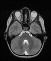 Chronic reactive multifocal osteomyelitis (CRMO) - mandible (Radiopaedia 56405-63069 Axial T2 25).jpg