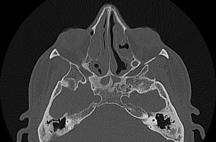 Chronic rhinosinusitis (Radiopaedia 65079-74075 Axial bone window 44).jpg