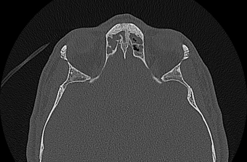 Chronic rhinosinusitis (Radiopaedia 65079-74075 Axial bone window 64).jpg