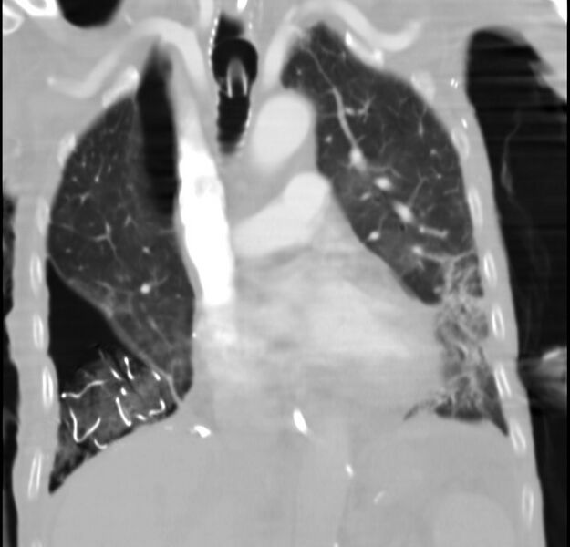 File:Clagett thoracotomy with bronchopleural fistula (Radiopaedia 29192-29587 Coronal lung window 18).jpg