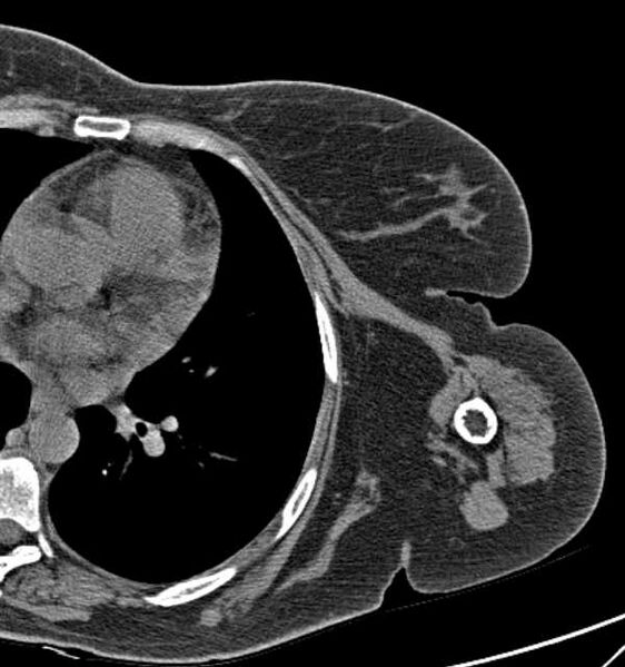File:Clear cell chondrosarcoma - humerus (Radiopaedia 63104-71612 Axial non-contrast 91).jpg
