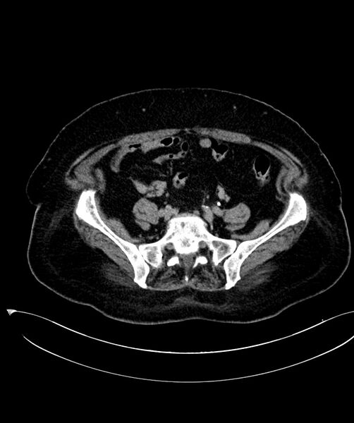 File:Clear cell renal cell carcinoma (Radiopaedia 85004-100537 F 41).jpg