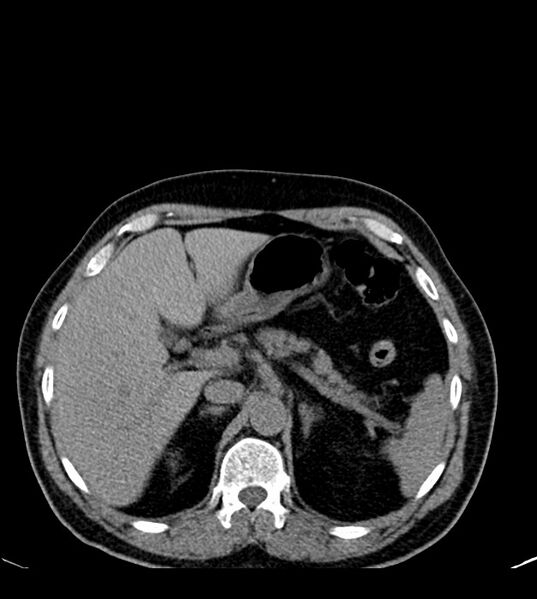 File:Clear cell renal cell carcinoma (Radiopaedia 85006-100539 Axial non-contrast 26).jpg
