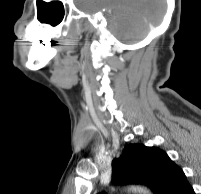 Colloid cyst of thyroid (Radiopaedia 22897-22923 Sagittal C+ delayed 39).jpg