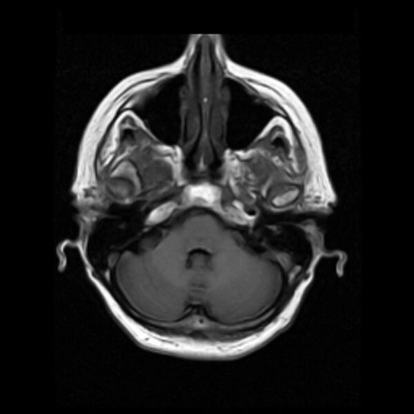 File:Colloid cyst with hydrocephalus (Radiopaedia 9373-10065 Axial T1 4).jpg