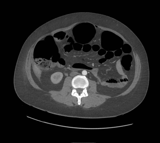 File:Colonic pseudo-obstruction (Radiopaedia 79752-92980 A 99).png