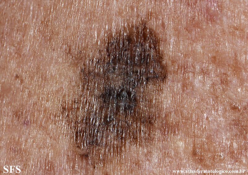 File:Melanoma (Dermatology Atlas 122).jpg