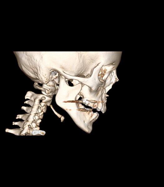 File:Nasoorbitoethmoid fracture (Radiopaedia 90044-107205 3D VRT 1).jpg