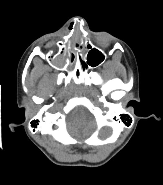 File:Nasoorbitoethmoid fracture (Radiopaedia 90044-107205 Axial non-contrast 139).jpg