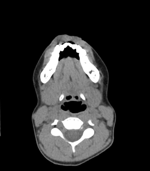 File:Nasoorbitoethmoid fracture (Radiopaedia 90044-107205 Axial non-contrast 52).jpg