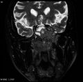 Nasopharyngeal carcinoma (Radiopaedia 4546-6667 Coronal T2 4).jpg