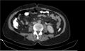 Necrotizing pancreatitis (Radiopaedia 20595-20495 Axial C+ delayed 25).jpg