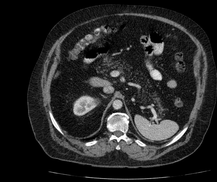 Nephroptosis with inguinal hernia containing perirenal fat (Radiopaedia 56632-63391 C 109).jpg