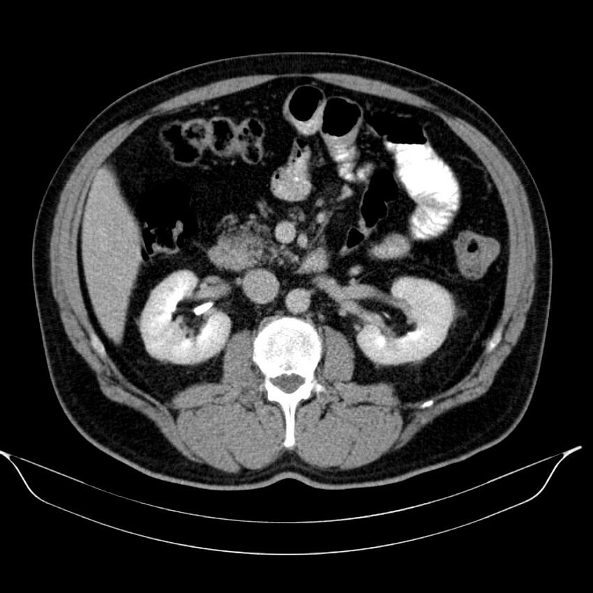 Neuroendocrine tumor of head of pancreas (Radiopaedia 57538-64502 D 37).jpg