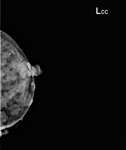 File:Neurofibromatosis of the breast (Radiopaedia 49024-54114 D 1).jpeg