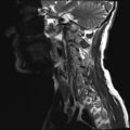 Neurofibromatosis type 1 (Radiopaedia 80355-93740 Sagittal T2 10).jpg